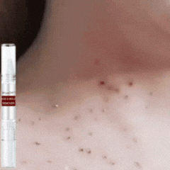 DermaFix™ | Tags & Moles Remover Serum Pen