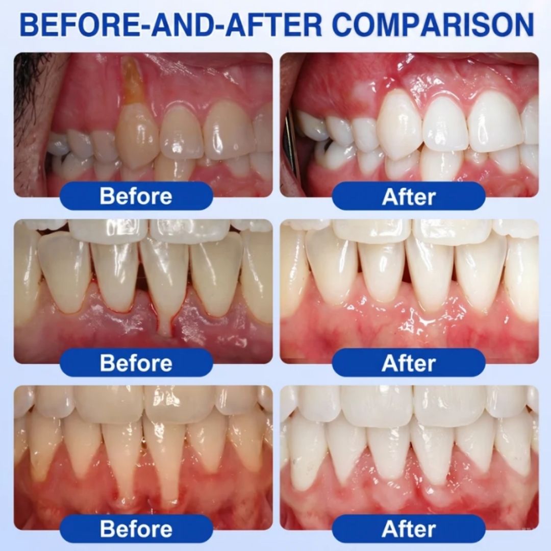 GumSeal™ | Periodontal Repair Gel
