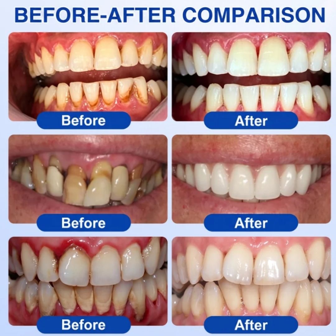 GumSeal™ | Periodontal Repair Gel