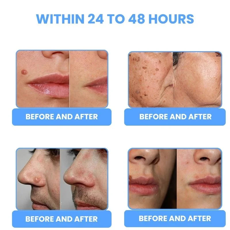 LaserPen™ | Precision Plasma Skin Corrector
