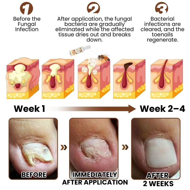 FungaBee® | Nail Care Spray with Bee Venom