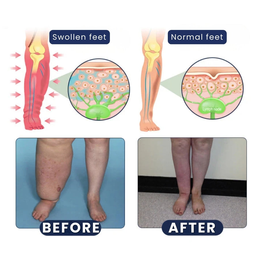 SwelRelief™ | Cream for Relief of Leg Swelling