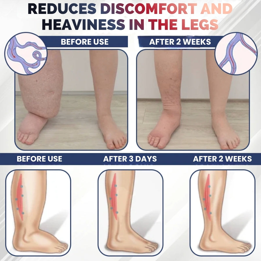 SwelRelief™ | Cream for Relief of Leg Swelling