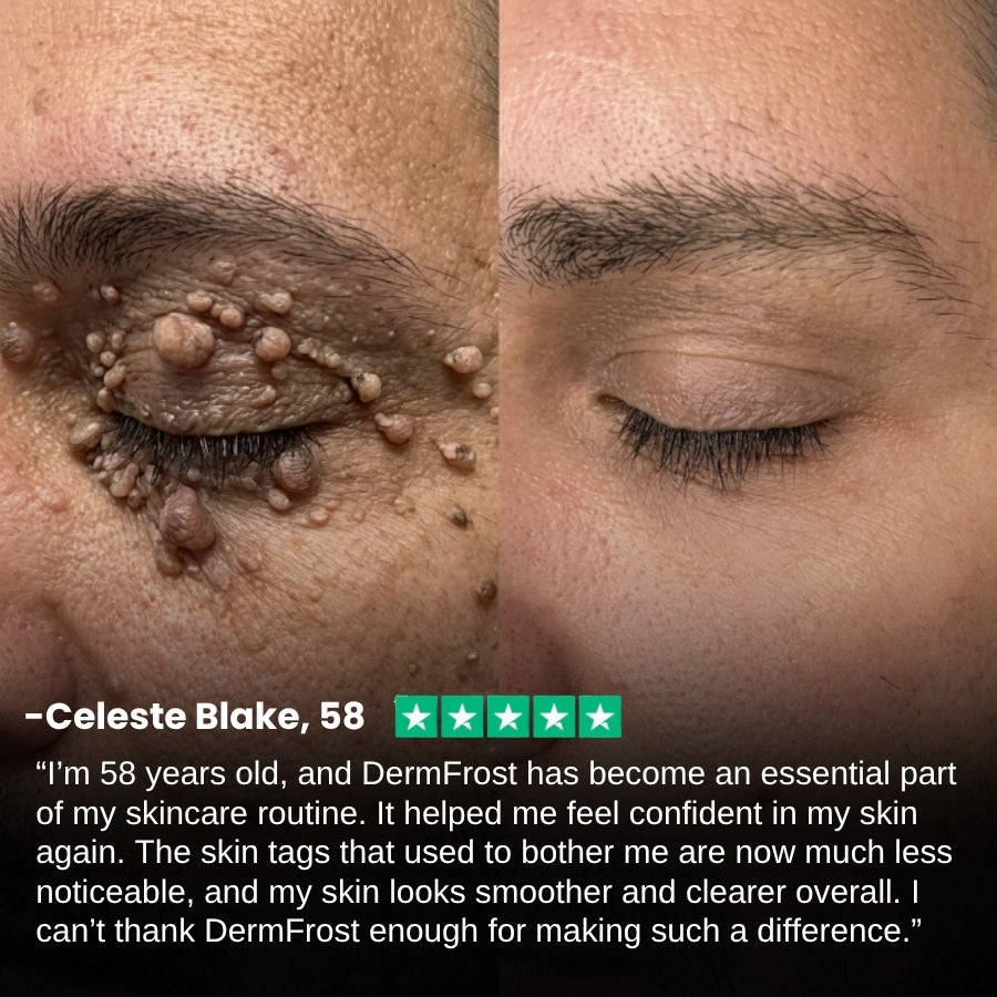 DermFrost™ |  Skin Tag Cryo Recovery Spray