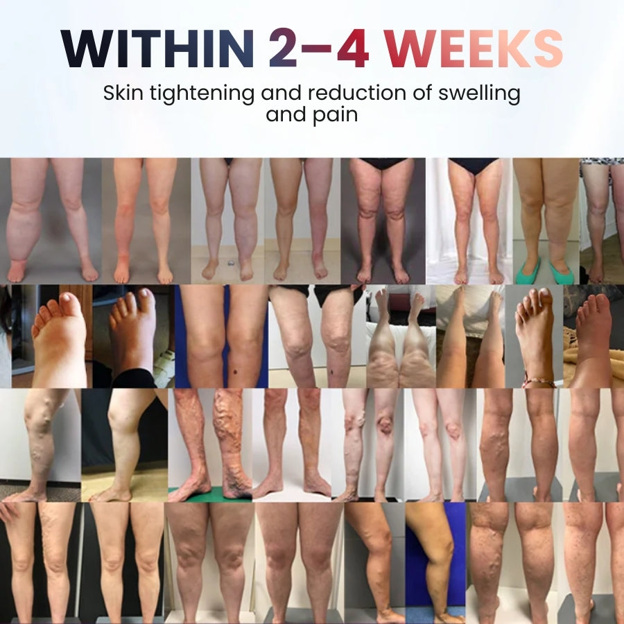 SwelRelief™ | Cream for Relief of Leg Swelling