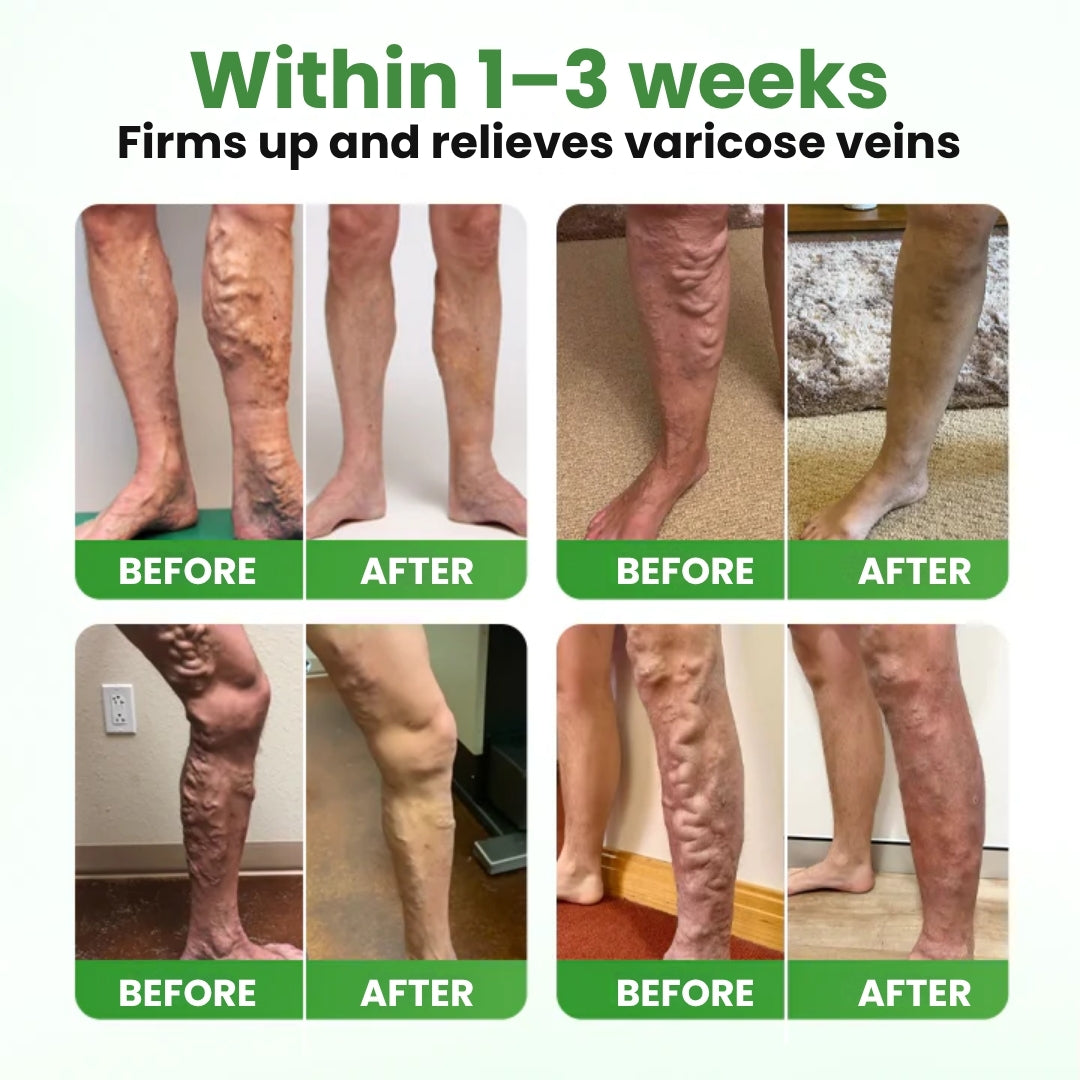 VeinHeal™ | Microneedle Patch