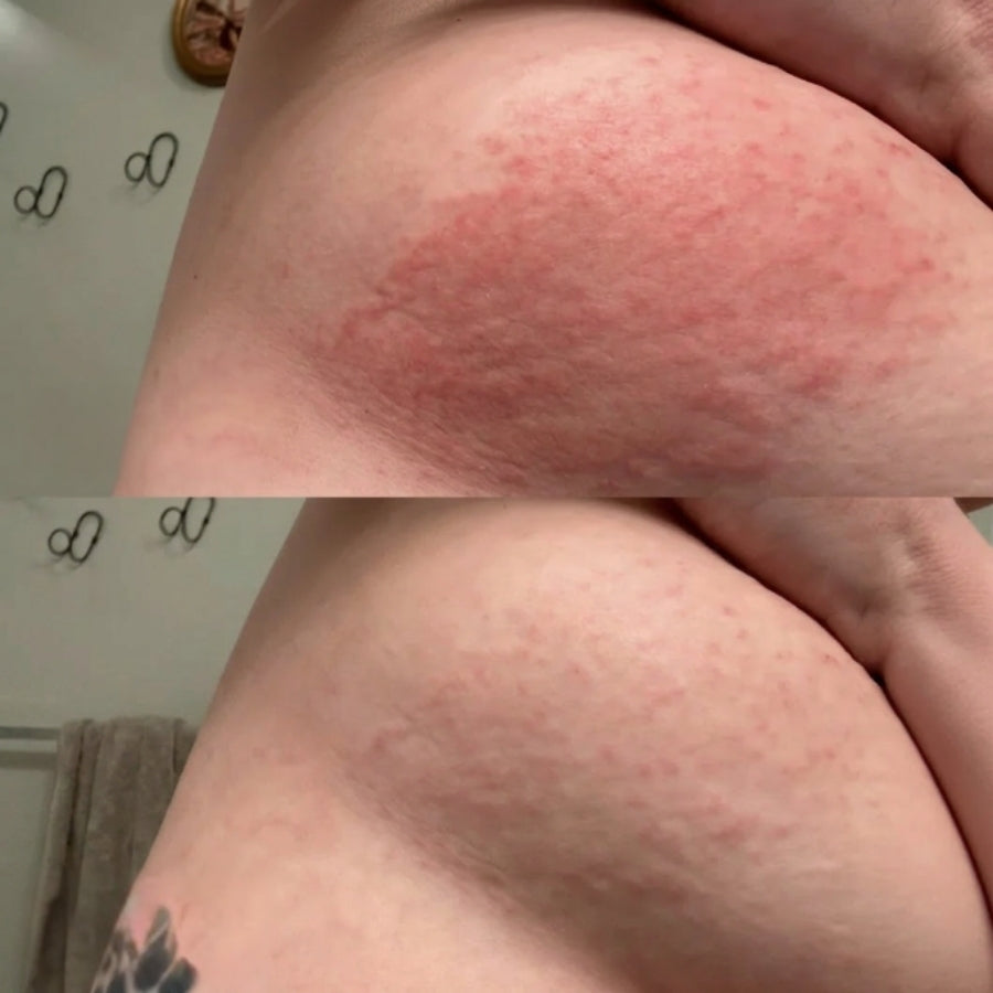 DermaCare™ | Intertrigo Relief Cream