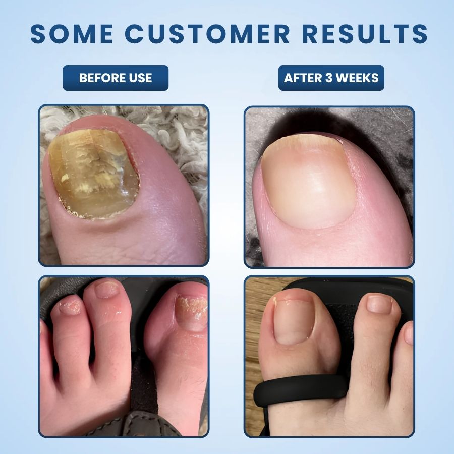 NailRestore™ | Night Nail Fungus Patches
