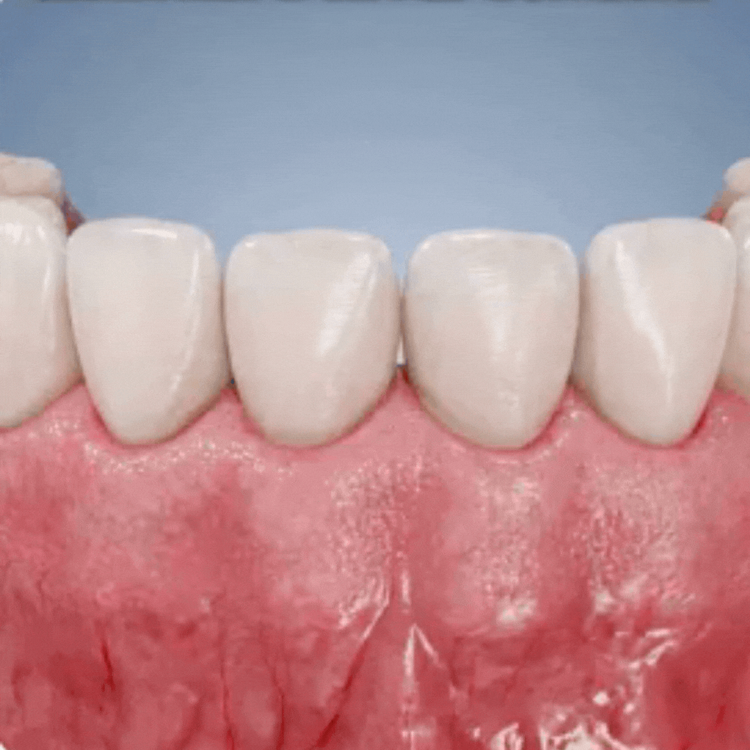 GumSeal™ | Periodontal Repair Gel