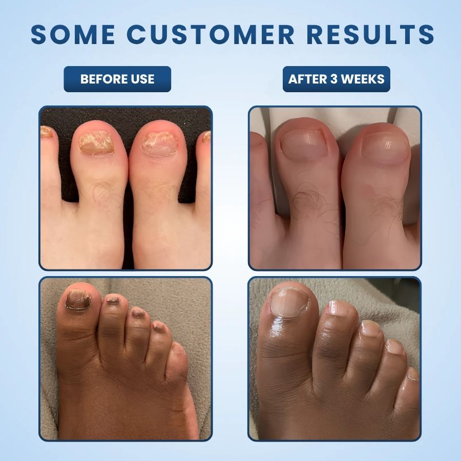 NailRestore™ | Night Nail Fungus Patches