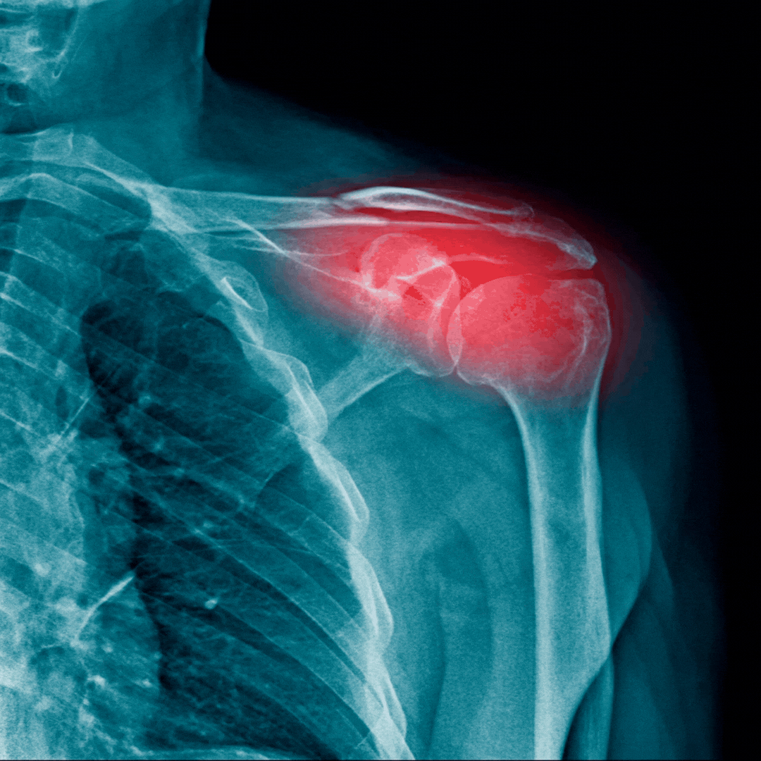 NeuroBalm™ | Magnesium Cream for Shoulder Pain